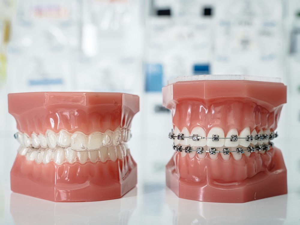 Dental models showing clear aligners and braces
