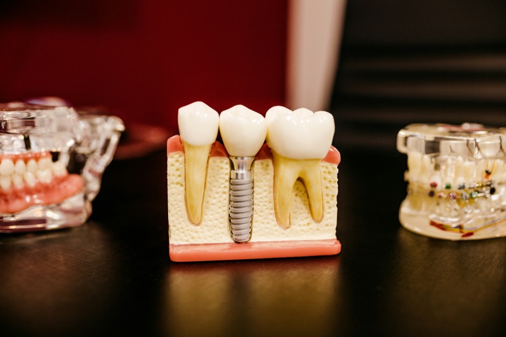 Dental model with crown and implant